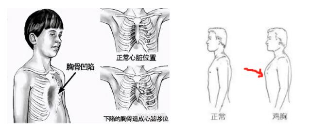 鸡胸是什么？