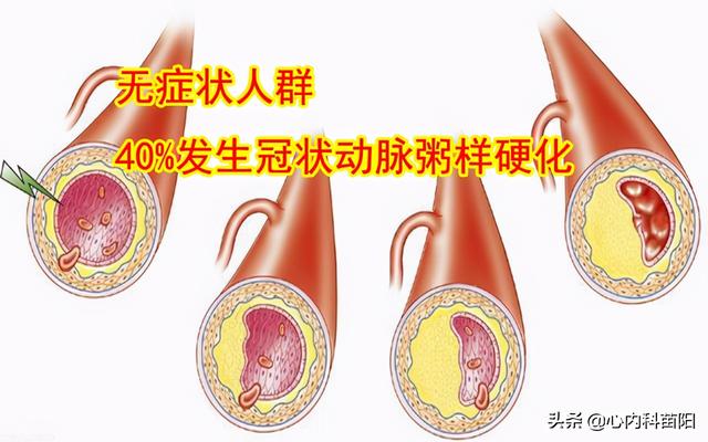 动脉硬化不能吃什么食物，脑梗的根源发现了,4种食物请忌口,越吃血液越粘稠