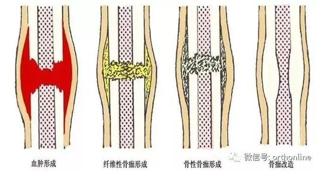 什么是骨折的图片大全，骨折的愈合过程分为