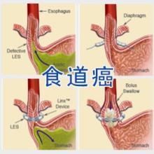 自酿的酸梅酒为什么发霉的东西，食道癌饮食应注意什么