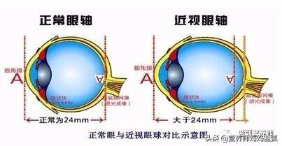 吃什么可以治疗近视，青少年近视眼补充什么营养