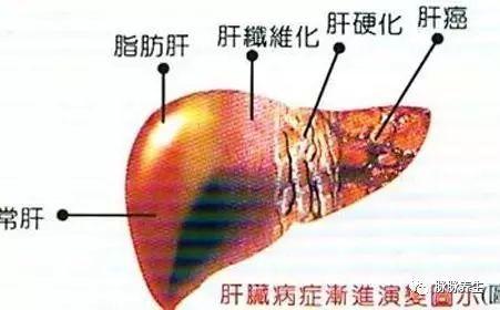 脂肪肝应该吃什么，怎么吃才能消除脂肪肝