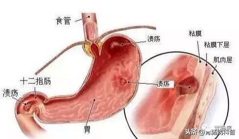 糜烂出血性胃炎吃什么好，糜烂性胃炎怎么治疗才能彻底治愈